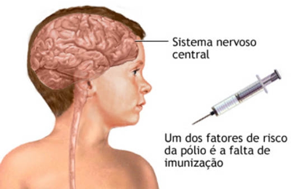 Polio