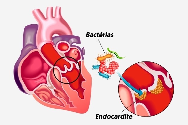 endocardite
