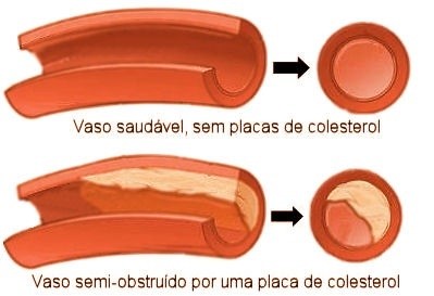 colesterol lipidios fabio argenta