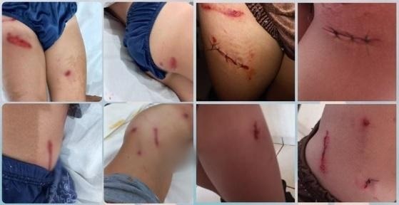 crianca ataque cao menino 6 anos