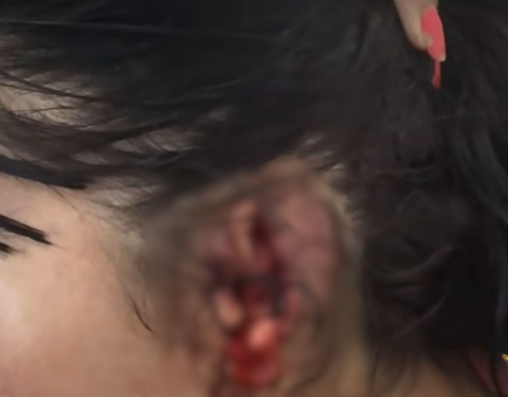 Homem morde e arranca orelha da esposa durante crise de ci&uacute;mes