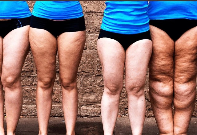 Lipedema &iuml;&iquest;&frac12; uma condi&iuml;&iquest;&frac12;&iuml;&iquest;&frac12;o cr&iuml;&iquest;&frac12;nica caracterizada pelo ac&iuml;&iquest;&frac12;mulo anormal de gordura e incha&iuml;&iquest;&frac12;o