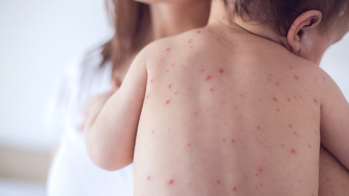 Bebê com meningite
