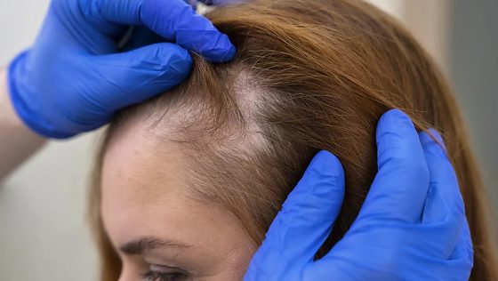  Alopécia feminina - queda de cabelo em mulheres